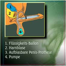 Eine schon implantierte aufblasbare Penis-Prothese